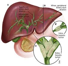 biliary track cancer